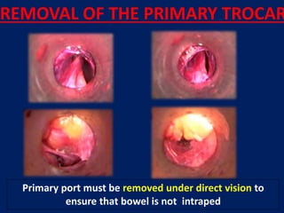 REMOVAL OF THE PRIMARY TROCAR
Primary port must be removed under direct vision to
ensure that bowel is not intraped
 