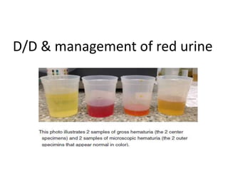 D/D & management of red urine
 