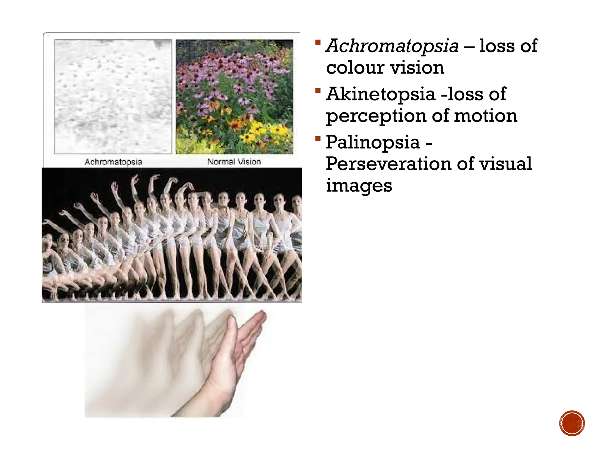  Achromatopsia – loss of
colour vision
 Akinetopsia -loss of
perception of motion
 Palinopsia -
Perseveration of visual
images
 
