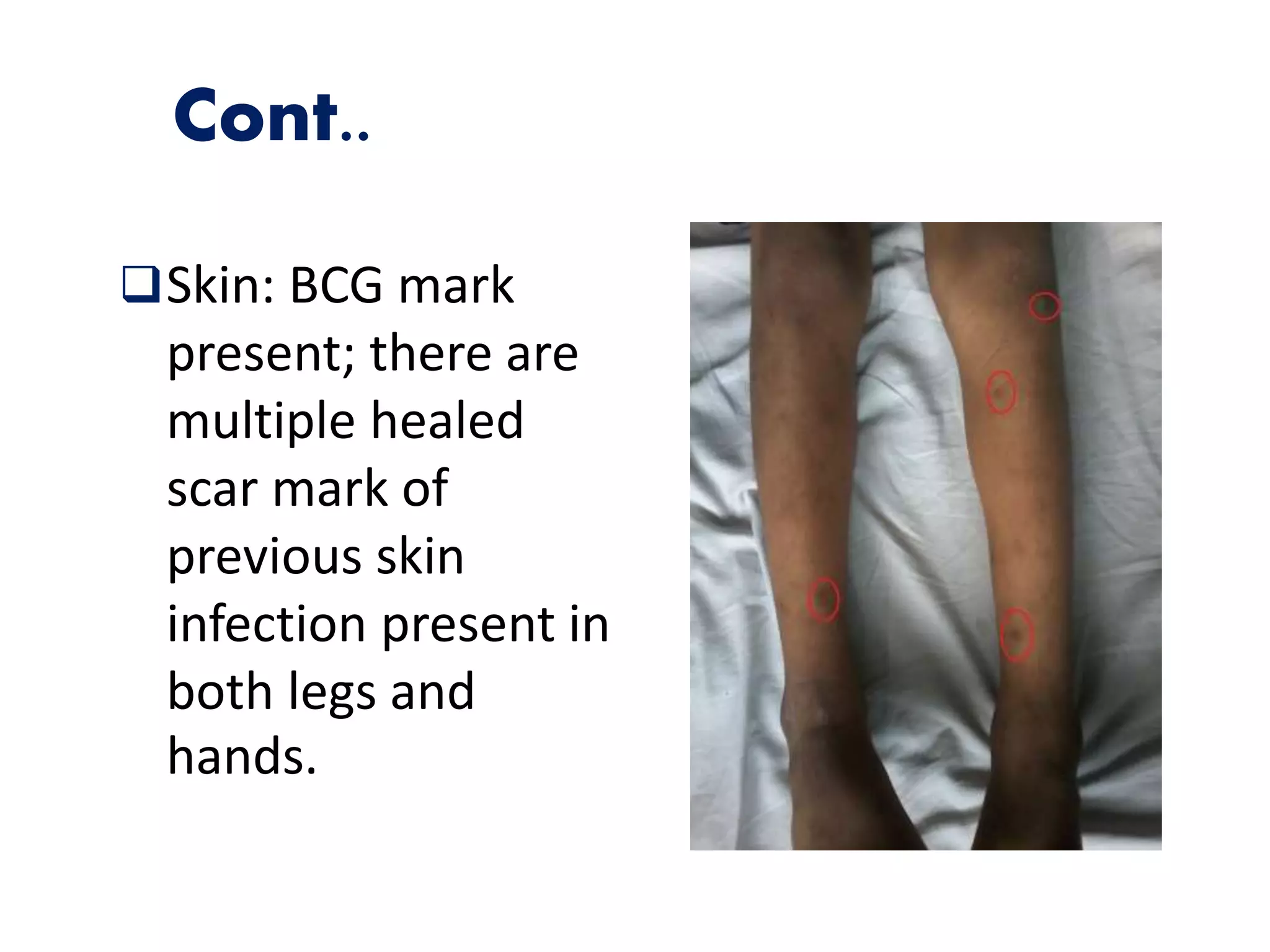 Cont..
Skin: BCG mark
present; there are
multiple healed
scar mark of
previous skin
infection present in
both legs and
hands.
 