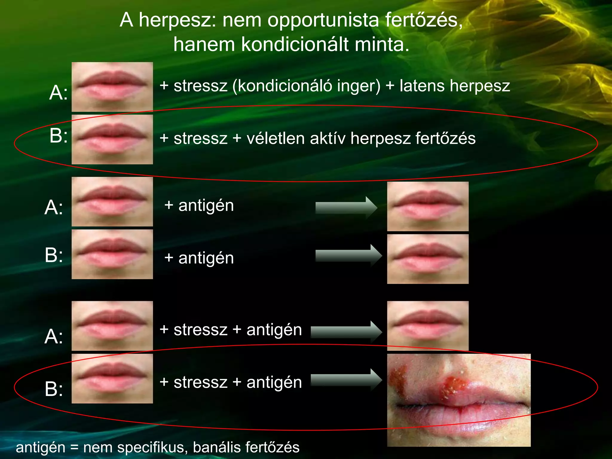 A herpesz: nem opportunista fertőzés,
hanem kondicionált minta.
+ stressz + véletlen aktív herpesz fertőzés
+ stressz (kondicionáló inger) + latens herpeszA:
B:
A:
B: + stressz + antigén
+ stressz + antigén
A:
B:
+ antigén
+ antigén
antigén = nem specifikus, banális fertőzés
 