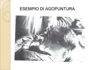 LA QUANTITÀ DEL PROBLEMA.
I dati verificabili presso l’istituto superiore di Sanità:
 L’AGOPUNTURA è la quarta cura più diffusa

 tra i nove milioni di utenti che si curano con le
  medicine o metodi alternativi o complementari
  adottata dal
 5% DELLE PERSONE DOPO L’OMEOPATIA (27,3%)
 MASSAGGI (20,5%)
 FITOTERAPIA (10%)
 19 MILIONI DI PERSONE curano la lombalgia con

  L’ANALGESIA AGOPUNTURA E LA
  FITOTERAPIA. (Di Stanislao 2000)
 