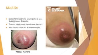 Mastite
 Geralmente acomete só um peito e após
duas semanas de parto;
 Quando não tratado evolui para abcesso;
 Não é contraindicada a amamentação
Abcesso mamário
 