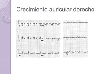 Crecimiento auricular derecho

 