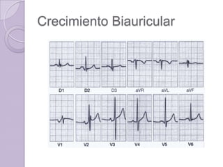 Crecimiento Biauricular

 