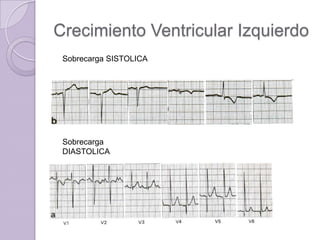Crecimiento Ventricular Izquierdo
Sobrecarga SISTOLICA

Sobrecarga
DIASTOLICA

 