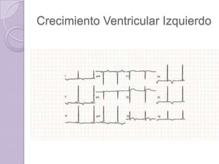 Crecimiento Ventricular Izquierdo

 