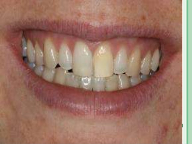 Get The shiny White Teeth By Teeth Whitening and Polishing