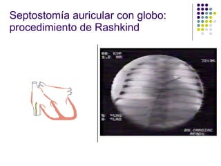 Conservative Rashkind Bas Evaluación del Recién Nacido Cianótico | PPT