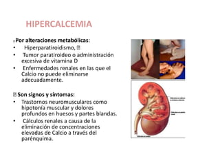 HIPERCALCEMIA
Por alteraciones metabólicas:
• Hiperparatiroidismo,
• Tumor paratiroideo o administración
excesiva de vitamina D
• Enfermedades renales en las que el
Calcio no puede eliminarse
adecuadamente.
Son signos y síntomas:
• Trastornos neuromusculares como
hipotonía muscular y dolores
profundos en huesos y partes blandas.
• Cálculos renales a causa de la
eliminación de concentraciones
elevadas de Calcio a través del
parénquima.
 
