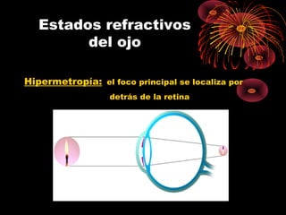 Hipermetropía: el foco principal se localiza por
detrás de la retina
Estados refractivos
del ojo
 