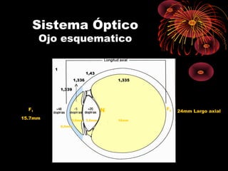 Sistema Óptico
Ojo esquematico
1
1,339
1,336
1,43
1,335
16mm3,6mm3,5mm
0,6mm
F1
15.7mm
F2N 24mm Largo axial
 