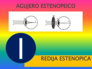 AGUJERO ESTENOPEICOREDIJA ESTENOPICA