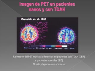 Etiología.NeuroanatomíaMenor tamaño cerebral (4%): lóbulo frontal derecho (8%).Menor tamaño ganglios basales (6%). Normalización 18 años.Menor tamaño del cerebelo (12%). Más pronunciado 18años