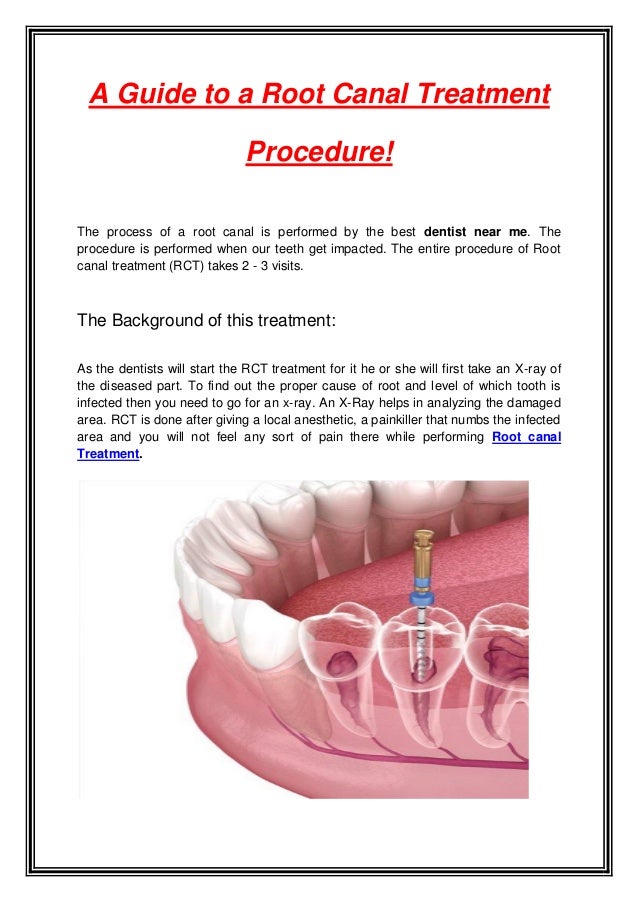 A Guide to a Root Canal Treatment
Procedure!
The process of a root canal is performed by the best dentist near me. The
procedure is performed when our teeth get impacted. The entire procedure of Root
canal treatment (RCT) takes 2 - 3 visits.
The Background of this treatment:
As the dentists will start the RCT treatment for it he or she will first take an X-ray of
the diseased part. To find out the proper cause of root and level of which tooth is
infected then you need to go for an x-ray. An X-Ray helps in analyzing the damaged
area. RCT is done after giving a local anesthetic, a painkiller that numbs the infected
area and you will not feel any sort of pain there while performing Root canal
Treatment.
 