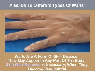 A Guide To Different Types Of Warts 
Warts Are A Form Of Skin Disease. 
They May Appear In Any Part Of The Body. 
Skin Wart Removal Is Necessary, When They 
Become Very Painful. 
 