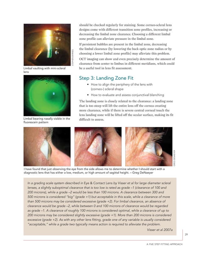 A guide to scleral lens fitting