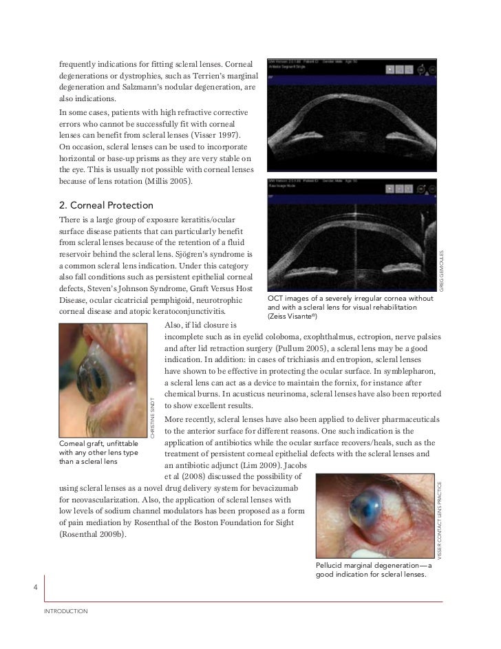 A guide to scleral lens fitting
