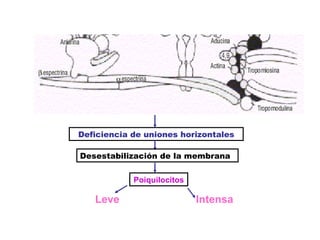 Deficiencia de uniones horizontales Desestabilización de la membrana Poiquilocitos  Intensa Leve 