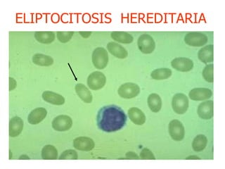 ELIPTOCITOSIS  HEREDITARIA  