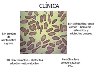 CLÍNICA Hemólisis leve compensada por MO. EIH común: de asintomática a grave. EIH esferocítica: poco común – hemólisis - esferocitos y eliptocitos gruesos EIH OSA: hemólisis - eliptocitos redondos - estomatocitos. 