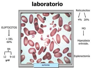 laboratorio g/dl Reticulocitos ELIPTOCITOS + DEL 60% Hb 9-10 12 4% 20% MO Hiperplasia eritroide. Esplenectomía 