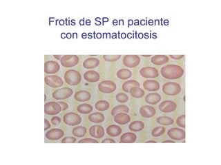 Frotis de SP en paciente con estomatocitosis 