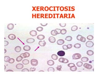 XEROCITOSIS HEREDITARIA 