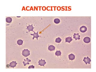ACANTOCITOSIS 