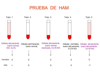 PRUEBA  DE  HAM Tubo  1 Tubo  5 Tubo  4 Tubo  3 Tubo  2 Células del paciente,  suero normal, HCl  0.2 N Células del Paciente,  suero normal,  Células del paciente, suero normal inactivado, 0.2 N HCl Células  normales,  suero del paciente,  0.2 N HCl Células  del paciente  suero del paciente,  0.2 N HCl Hemólisis 0 0 0 0 0 HPN 0 0 0 +* + 