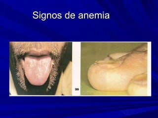 Signos de anemia
 