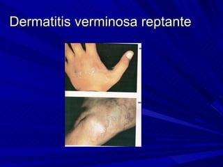 Dermatitis verminosa reptante
 