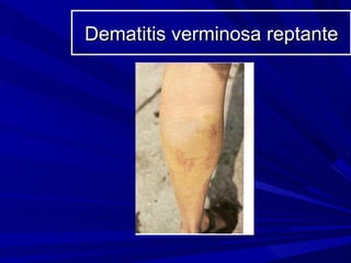 Dematitis verminosa reptante
 