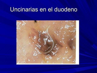 Uncinarias en el duodeno
 