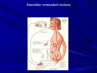 Enterobius vermicularis (oxiuro)
 