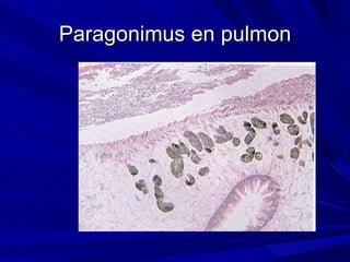 Paragonimus en pulmon
 