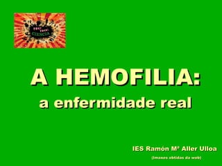 A HEMOFILIA:A HEMOFILIA:
a enfermidade reala enfermidade real
(Imaxes obtidas da web)(Imaxes obtidas da web)
IES Ramón Mª Aller UlloaIES Ramón Mª Aller Ulloa
 