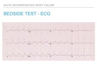 ACUTE DECOMPENSATED HEART FAILURE
BEDSIDE TEST - ECG
 