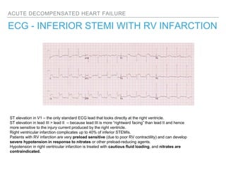 ACUTE DECOMPENSATED HEART FAILURE
ECG - INFERIOR STEMI WITH RV INFARCTION
ST elevation in V1 – the only standard ECG lead that looks directly at the right ventricle.
ST elevation in lead III > lead II – because lead III is more “rightward facing” than lead II and hence
more sensitive to the injury current produced by the right ventricle.
Right ventricular infarction complicates up to 40% of inferior STEMIs.
Patients with RV infarction are very preload sensitive (due to poor RV contractility) and can develop
severe hypotension in response to nitrates or other preload-reducing agents.
Hypotension in right ventricular infarction is treated with cautious fluid loading, and nitrates are
contraindicated.
 