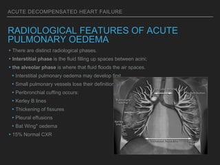 ACUTE DECOMPENSATED HEART FAILURE
RADIOLOGICAL FEATURES OF ACUTE
PULMONARY OEDEMA
▸There are distinct radiological phases.
▸Interstitial phase is the fluid filling up spaces between acini;
▸the alveolar phase is where that fluid floods the air spaces.
▸Interstitial pulmonary oedema may develop first.
▸Small pulmonary vessels lose their definition
▸Peribronchial cuffing occurs:
▸Kerley B lines
▸Thickening of fissures
▸Pleural effusions
▸Bat Wing" oedema
▸15% Normal CXR
 