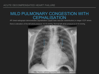ACUTE DECOMPENSATED HEART FAILURE
MILD PULMONARY CONGESTION WITH
CEPHALISATIONAP chest radiograph demonstrates cephalisation (upper lobe vascular redistribution) in stage I CCF where
there is elevation of the left atrial pressure 10-15 mmHg. Normal left atrial pressure is 5-10 mmHg.
http://www.radiologyassistant.nl/en/p4c132f36513d4
 