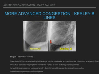 ACUTE DECOMPENSATED HEART FAILURE
MORE ADVANCED CONGESTION - KERLEY B
LINES
Stage II - Interstitial oedema
Stage II of CHF is characterised by fluid leakage into the interlobular and peribronchial interstitium as a result of the i
When fluid leaks into the peripheral interlobular septa it is seen as Kerley B or septal lines.
Kerley-B lines are seen as peripheral short 1-2 cm horizontal lines near the costophrenic angles.
These lines run perpendicular to the pleura.
 