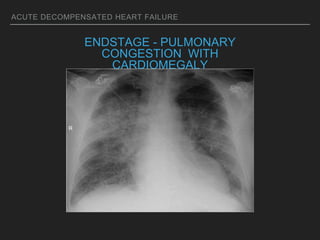 ACUTE DECOMPENSATED HEART FAILURE
ENDSTAGE - PULMONARY
CONGESTION WITH
CARDIOMEGALY
 