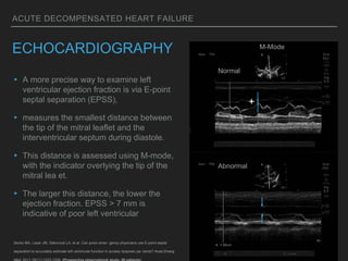 ACUTE DECOMPENSATED HEART FAILURE
ECHOCARDIOGRAPHY
▸ A more precise way to examine left
ventricular ejection fraction is via E-point
septal separation (EPSS),
▸ measures the smallest distance between
the tip of the mitral leaflet and the
interventricular septum during diastole.
▸ This distance is assessed using M-mode,
with the indicator overlying the tip of the
mitral lea et.
▸ The larger this distance, the lower the
ejection fraction. EPSS > 7 mm is
indicative of poor left ventricular
Secko MA, Lazar JM, Salciccioli LA, et al. Can junior emer- gency physicians use E-point septal
separation to accurately estimate left ventricular function in acutely dyspneic pa- tients? Acad Emerg
Normal
Normal
Abnormal
M-Mode
 