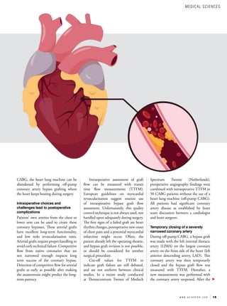 15
w w w . a s i a n h h m . c o m
CABG, the heart lung machine can be
abandoned by performing off-pump
coronary artery bypass grafting where
the heart keeps beating during surgery.
Intraoperative choices and
challenges lead to postoperative
complications
Patients’ own arteries from the chest or
lower arm can be used to create these
coronary bypasses. These arterial grafts
have excellent long-term functionality,
and low redo revascularisation rates.
Arterial grafts require proper handling to
avoid early technical failure. Competitive
flow from native coronaries that are
not narrowed enough impacts long
term success of the coronary bypass.
Detection of competitive flow for arterial
grafts as early as possible after making
the anastomosis might predict the long-
term patency.
Intraoperative assessment of graft
flow can be measured with transit
time flow measurements (TTFM).
European guidelines on myocardial
revascularisation suggest routine use
of intraoperative bypass graft flow
assessment. Unfortunately, this quality
control technique is not always used, nor
handled upon adequately during surgery.
The first signs of a failed graft are heart
rhythm changes, postoperative new onset
of chest pain and a potential myocardial
infarction might occur. Often, the
patient already left the operating theatre,
and bypass graft revision is not possible,
or should be considered for another
surgical procedure.
Cut-off values for TTFM to
indicate graft failure are still debated,
and are not uniform between clinical
studies. In a recent study conducted
at Thoraxcentrum Twente of Medisch
Spectrum Twente (Netherlands),
preoperative angiography findings were
combined with intraoperative TTFM in
50 CABG patients without the use of a
heart lung machine (off-pump CABG).
All patients had significant coronary
artery disease as established by heart
team discussion between a cardiologist
and heart surgeon.
Temporary closing of a severely
narrowed coronary artery
During off-pump CABG, a bypass graft
was made with the left internal thoracic
artery (LIMA) on the largest coronary
artery on the front side of the heart (left
anterior descending artery, LAD). This
coronary artery was then temporarily
closed and the bypass graft flow was
measured with TTFM. Hereafter, a
new measurement was performed with
the coronary artery reopened. After the
MEDICAL SCIENCES
 