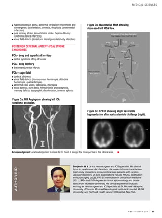 33
w w w . a s i a n h h m . c o m
hypersomnolence, coma, abnormal vertical eye movements and
convergence, disorientation, amnesia, dysphasia (anteromedial
infarction)
pure sensory stroke, sensorimotor stroke, Dejerine-Roussy
syndrome (lateral infarction)
visual field defects (dorsal and lateral geniculate body infarction)
POSTERIOR CEREBRAL ARTERY (PCA) STROKE
SYNDROMES
PCA - deep and superficial territory
part of syndrome of top of basilar
PCA - deep territory
thalamopeduncular infarcts
PCA – superficial
cortical blindness
visual field defects (homonymous hemianopia, altitudinal
hemianopia, quadrantanopia)
abnormal color vision, pallinopsia, micropsia
visual agnosia, pure alexia, hemidyslexia, prosopagnosia,
memory deficits, topographic disorientation, amnesic aphasia
Figure 3a. MR Angiogram showing left ICA
functional occlusion.
Figure 3b. Quantitative MRA showing
decreased left MCA flow.
Figure 3c. SPECT showing slight reversible
hypoperfusion after acetazolamide challenge (right).
Acknowledgement: Acknowledgement is made to Dr. David J. Langer for his expertise in this clinical area.
Benjamin W Y Lo is a neurosurgeon and ICU specialist. His clinical
focus is cerebrovascular disorders. His research focus characterises
brain-body interactions in neurocritical care patients with cerebro-
vascular disorders. Dr. Lo’s qualifications include FRCSC certification
in neurosurgery (2009), FRCSC certification in critical care medicine
(2011), MSc and PhD degrees in clinical epidemiology and biosta-
tistics from McMaster University. His clinical experience includes
working as neurosurgeon and ICU specialist at St. Michael’s Hospital,
University of Toronto; Montreal Neurological Institute & Hospital, McGill
University; and Northwell Health Lenox Hill Hospital, New York.
AUTHOR
BIO
MEDICAL SCIENCES
 