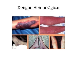 Dengue Hemorrágica:
 