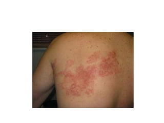 A história do aedes aegypti