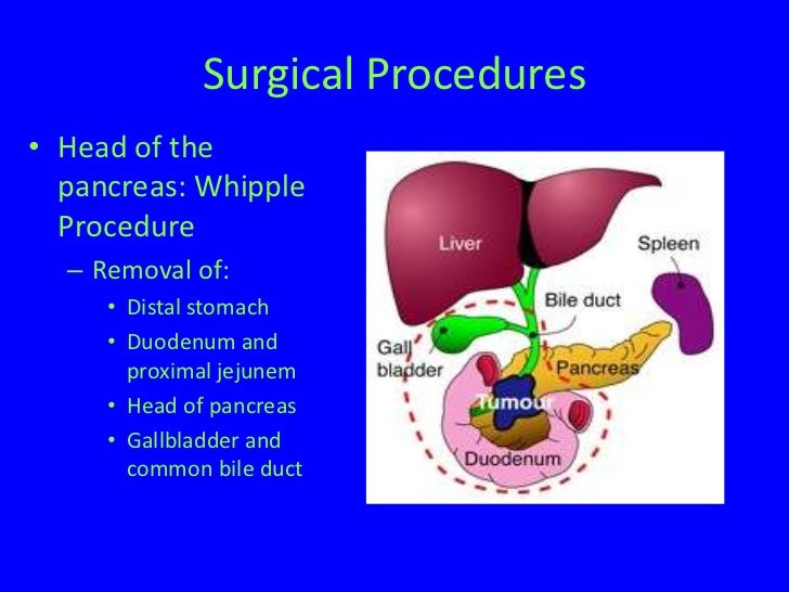 pancreatic-cancer