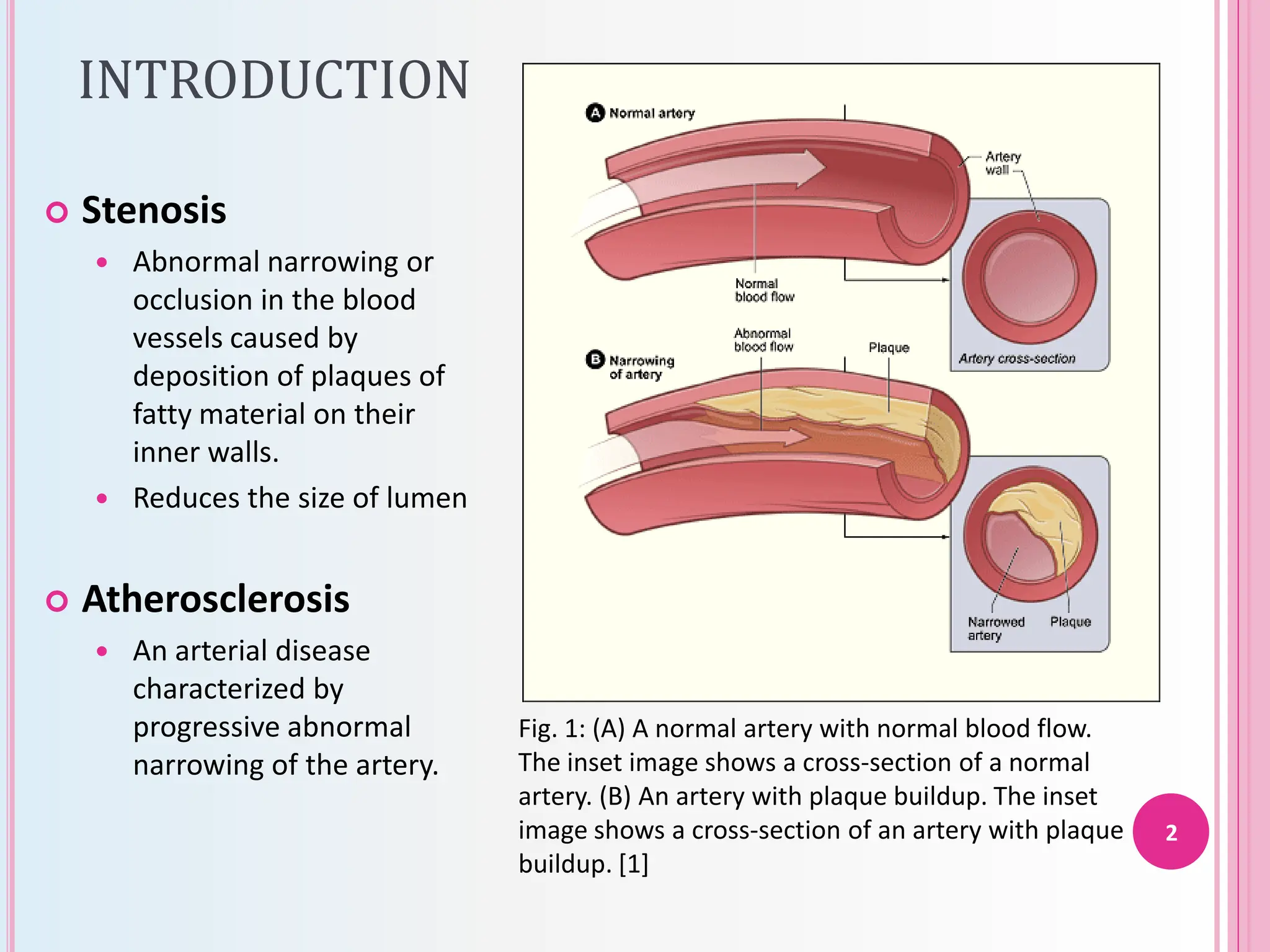 Flow Acceleration Computational simulation of blood flow in stenosed Arterial Bifurcation ...